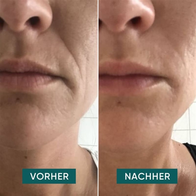 APRICOT wiederv Anti-Falt-Mund Pads Hyalur